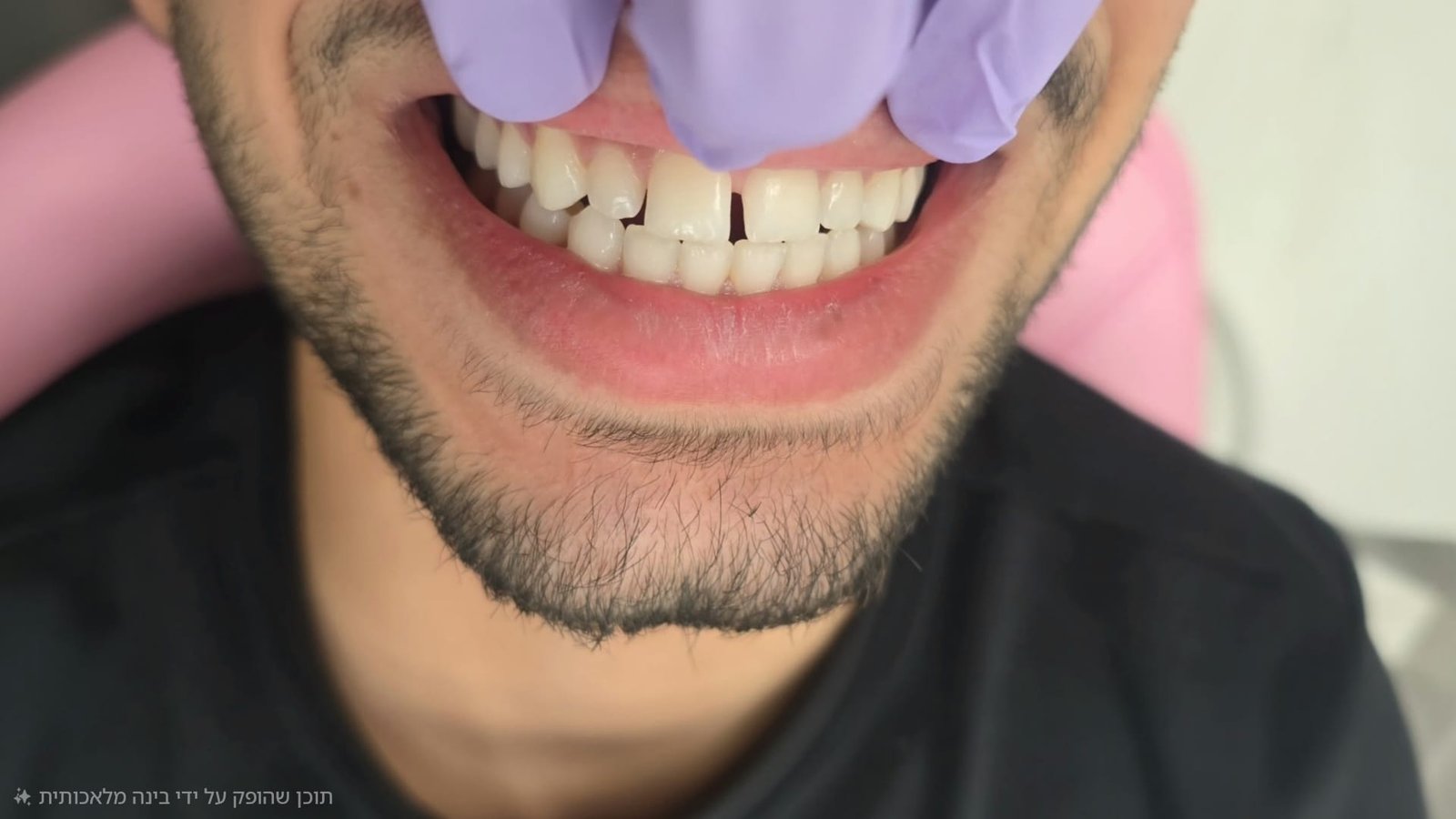 قبل العلاج